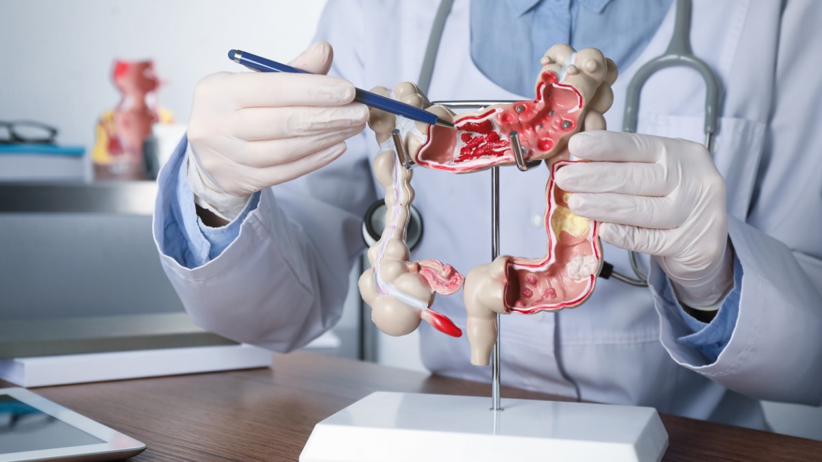colon model Photo of a doctor showing an model of the colon